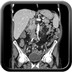 Adénocarcinome colique du colon transverse  TDM Abdomen Axial Temps veineux