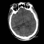 Traumatisme cranien et des membres inférieurs, pneumopathie d'inhalation crane axial mou Traumatisme cranien et des membres inférieurs, pneumopathie d'inhalation crane axial mou