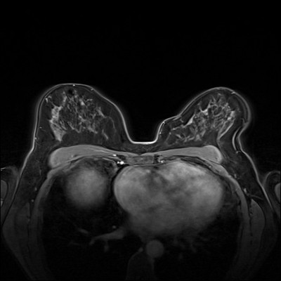 Right upper medial ductal carcinoma in situ Dynamique FS 2 min