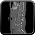 Craniocerebral trauma, Carotid artery injury with dissection, traumatic perforation of GI tract, pulmonary artery injury, Chance fracture Head CT, Axial plane, Soft tissue window