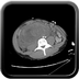 Clinical case 7 - Polytrauma due to road traffic accident, rear passenger, in hemorrhagic shock