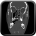 Clinical case 8 - Polytrauma due to a fall of a few meters following a loop while paragliding