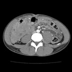 Lymphome iléo caecal TDM Abdomen Axial Temps veineux Lymphome iléo caecal TDM Abdomen Axial Temps veineux