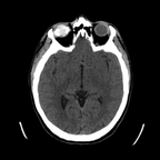 traumatisme thoracique, fracture-dislocation de L5, hernie discale post traumatique. crane axial mou traumatisme thoracique, fracture-dislocation de L5, hernie discale post traumatique. crane axial mou