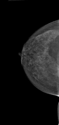 Right upper medial ductal carcinoma in situ RCC Acquisition Tomo