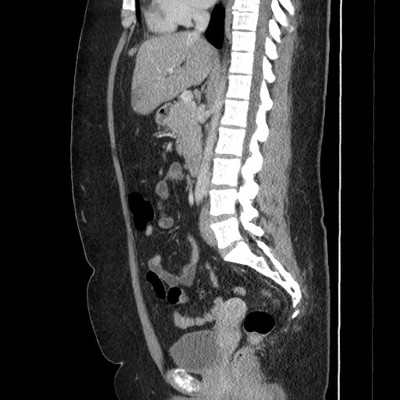 Phéochromocytome bilatéral, tumeurs rénales et kystes rénaux dans le cadre d'une maladie de Von Hippel Lindau TDM portal sagittal