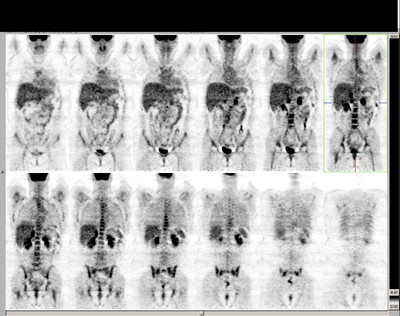 Phéochromocytome bilatéral, tumeurs rénales et kystes rénaux dans le cadre d'une maladie de Von Hippel Lindau TEP reconstruction