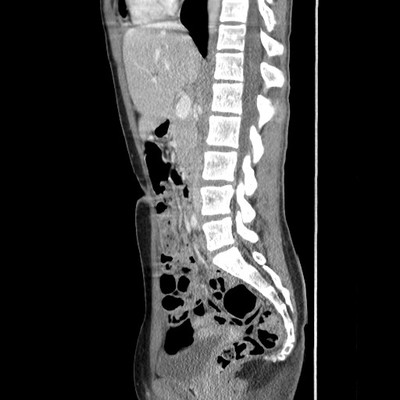 Phéochromocytome et paragangliome dans un contexte de maladie de Von Hippel Lindau TDM Sagittal