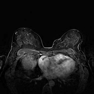 Right upper medial ductal carcinoma in situ Soustraction 3 min