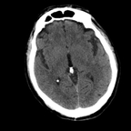 hémorragie sous arachnoïdienne, pneumothorax, fracture du sternum crane axial mou hémorragie sous arachnoïdienne, pneumothorax, fracture du sternum crane axial mou