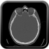 Clinical case 3 - Polytrauma due to a fall from a height of 5 m