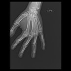 Энхондрома Radiographie Membre supérieur Энхондрома Radiographie Membre supérieur