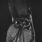 Тендовагинит де Кервена IRM poignet Coronal DP SPAIR Тендовагинит де Кервена IRM poignet Coronal DP SPAIR