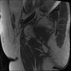 Двусторонний асептический остеонекроз головок бедренных костей IRM Sagittal T1 TSE Двусторонний асептический остеонекроз головок бедренных костей IRM Sagittal T1 TSE