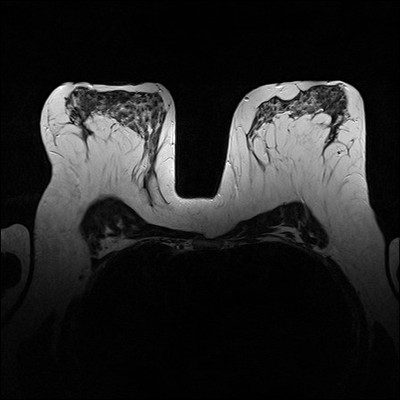 Doubt regarding architectural distortion of the right upper lateral quadrant, corresponding to superimpositions with tomosynthesis. T2