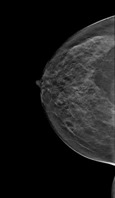 Right upper medial ductal carcinoma in situ RCC Tomosynthèse