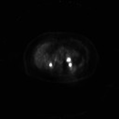 Phéochromocytome bilatéral, tumeurs rénales et kystes rénaux dans le cadre d'une maladie de Von Hippel Lindau TEP