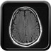 Dissection idiopathique artère cérébrale antérieure  Interventionnel Crâne