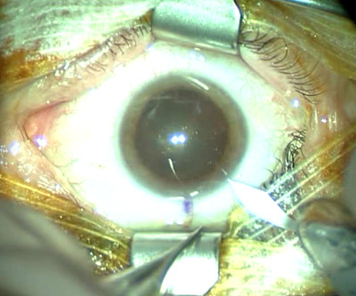 Cataracte sous capsulaire postérieure et astigmatisme cornéen - Implantation multifocale torique Pré op