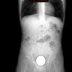 Boule de pétanque intrarectale TDM Abdomen Scoot Boule de pétanque intrarectale TDM Abdomen Scoot