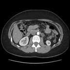 Phéochromocytome. TDM Abdomen Axial Temps artériel Phéochromocytome. TDM Abdomen Axial Temps artériel