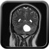 HEMANGIOBLASTOME  IRM Crâne Axial Gadolinium