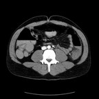 Péri artérite noueuse digestive TDM Abdomen Axial Temps artériel Péri artérite noueuse digestive TDM Abdomen Axial Temps artériel