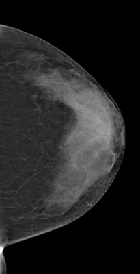 Doubt regarding architectural distortion of the right upper lateral quadrant, corresponding to superimpositions with tomosynthesis. LCC Acquisition Tomo