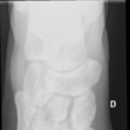 Fracture de contrainte du 1/3 distal du 3ème métatarsien Radiographie Pied Face Fracture de contrainte du 1/3 distal du 3ème métatarsien Radiographie Pied Face