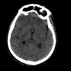 fracture du condyle occipital, traumatisme thoracique, fracture et contusion hépatique, hématome de la surrénale crane axial mou fracture du condyle occipital, traumatisme thoracique, fracture et contusion hépatique, hématome de la surrénale crane axial mou