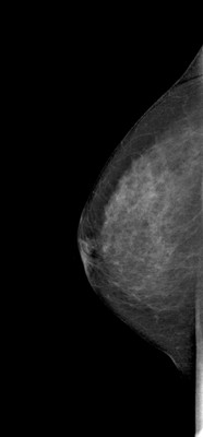 Right upper medial ductal carcinoma in situ RML Acqusition Tomo