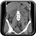 Douleurs de la fosse lombaire droite  Radiographie Abdomen Pelvis