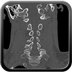 Clinical case 3 - Polytrauma due to a fall from a height of 5 m