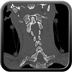 Clinical case 7 - Polytrauma due to road traffic accident, rear passenger, in hemorrhagic shock