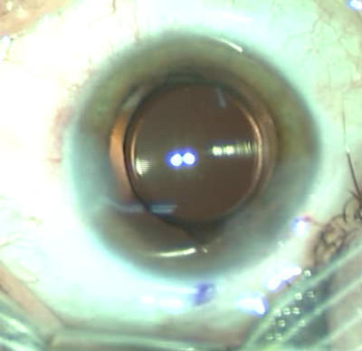 Cataracte sous capsulaire postérieure et astigmatisme cornéen - Implantation multifocale torique Position finale