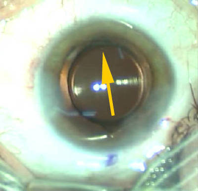 Cataracte sous capsulaire postérieure et astigmatisme cornéen - Implantation multifocale torique Position finale