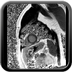 Infarctus du myocarde localisé au ventricule droit Perfusion de premier passage en petit axe