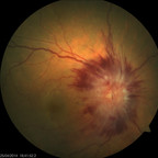 NOIAA sur neuropathie optique toxique à l'amiodarone FO OD NOIAA sur neuropathie optique toxique à l'amiodarone FO OD