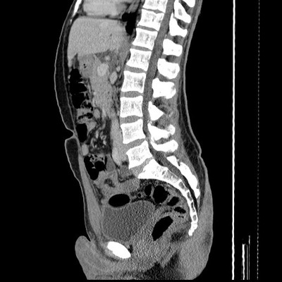 Découverte fortuite d'une masse pancréatique TDM sagittal