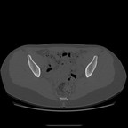 Хондросаркома на почве остеогенного экзостоза TDM Pelvis Axial Хондросаркома на почве остеогенного экзостоза TDM Pelvis Axial