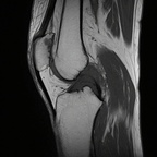 Мукоидная киста в коленном суставе IRM du genou Sagittal T1 TSE Мукоидная киста в коленном суставе IRM du genou Sagittal T1 TSE
