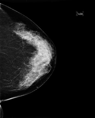Doubt regarding architectural distortion of the right upper lateral quadrant, corresponding to superimpositions with tomosynthesis. LCC
