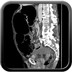 Vomiting and abdominal distension Axial