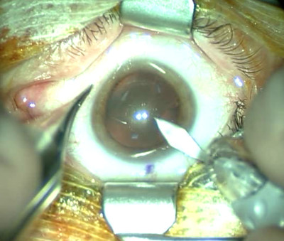 Cataracte sous capsulaire postérieure et astigmatisme cornéen - Implantation multifocale torique Incision cornéenne