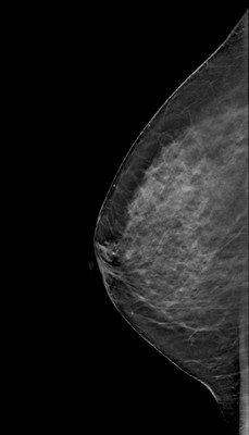 Right upper medial ductal carcinoma in situ RML Tomosynthèse