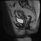 Cancer de l'endomètre avec extension loco-régionale et ganglionnaire Sagittal T2 Cancer de l'endomètre avec extension loco-régionale et ganglionnaire Sagittal T2