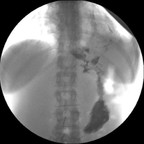 Fistule gastro bronchique post sleeve Transit pharyngo oesophagien, scopie. Fistule gastro bronchique post sleeve Transit pharyngo oesophagien, scopie.