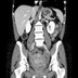 Abcès tubo ovarien bilatéral et pelvi péritonite  TDM Abdomen Axial Temps veineux