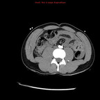 Hématome du foie avec saignement actif embolisé par coils TDM Abdomen Axial Temps artériel Hématome du foie avec saignement actif embolisé par coils TDM Abdomen Axial Temps artériel