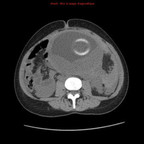 Rupture splénique spontanée chez une patiente enceinte TDM Abdomen Axial Sans injection Rupture splénique spontanée chez une patiente enceinte TDM Abdomen Axial Sans injection